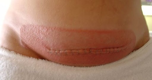 best doctor for caesarean section in Delhi