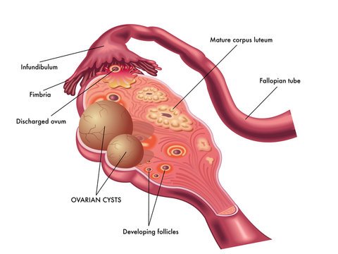 best doctor for ovarian cyst in Delhi